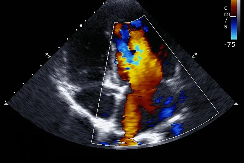 Is Blue Bad On An Echocardiogram